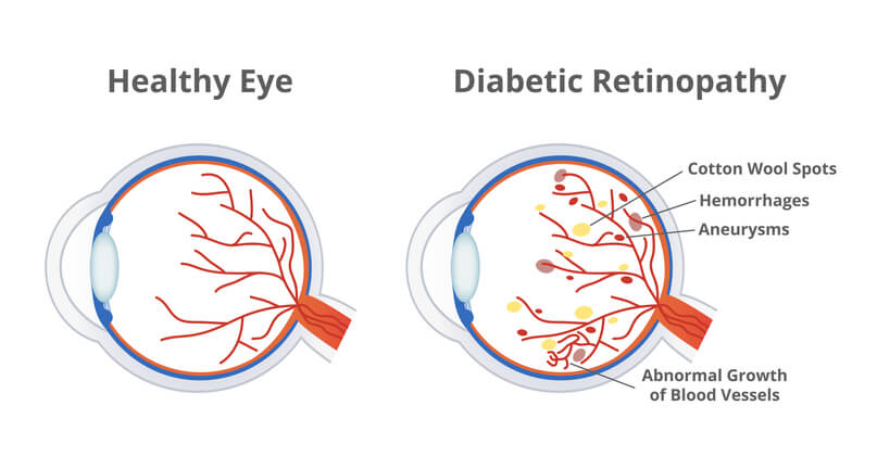 Diabetic retinopathy